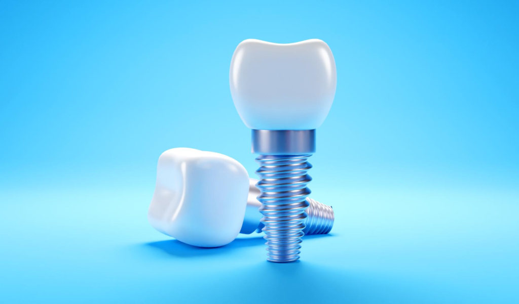Dental Implants – What You Should Know