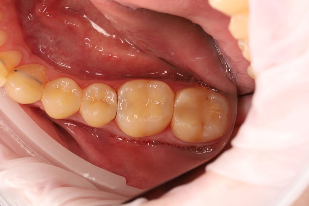 Treatment of interproximal caries after completion of orthodontic treatment.