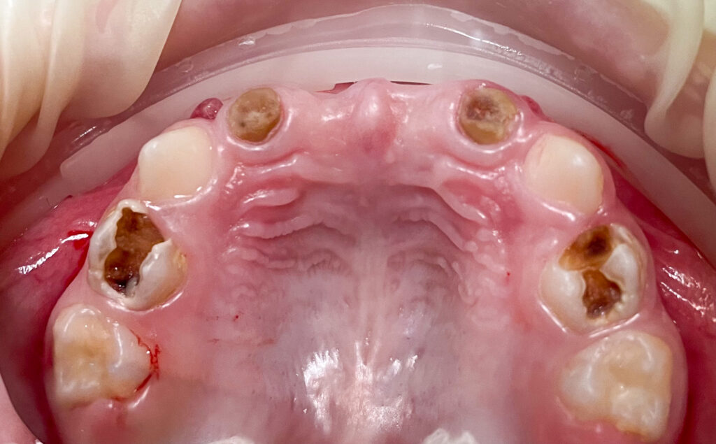 Comprehensive treatment of multiple carious lesions of primary teeth in an early childhood patient under general anesthesia.