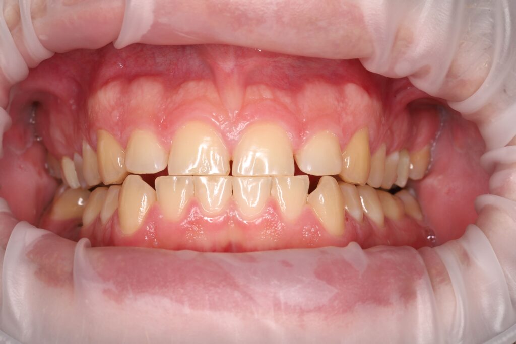 Professional tooth whitening using the Beyond system.