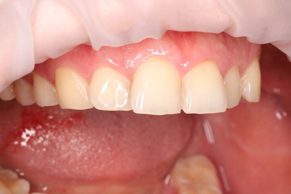 Treatment of secondary caries prior to orthodontic treatment.