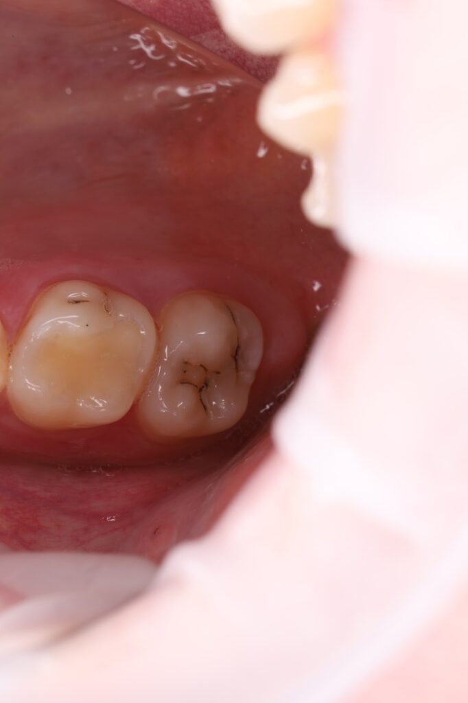 Treatment of interproximal caries and aesthetic restoration with composite material.