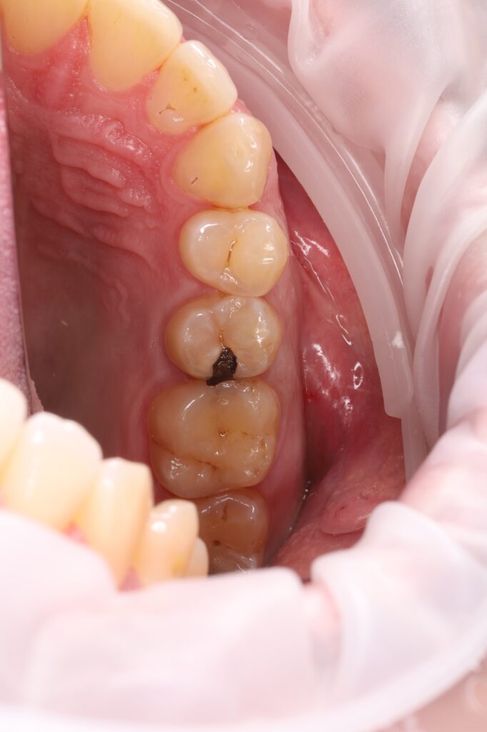 Microscope-assisted endodontic treatment and tooth restoration for subsequent prosthetic rehabilitation.