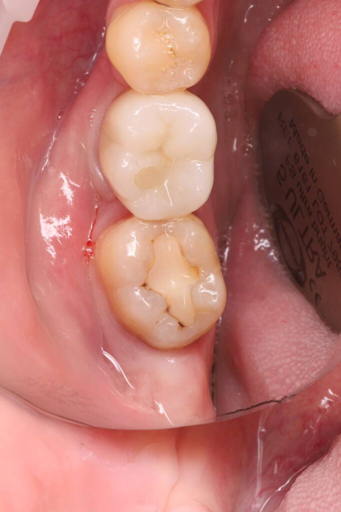 Removal of carious lesions and anatomical composite restoration of the tooth.
