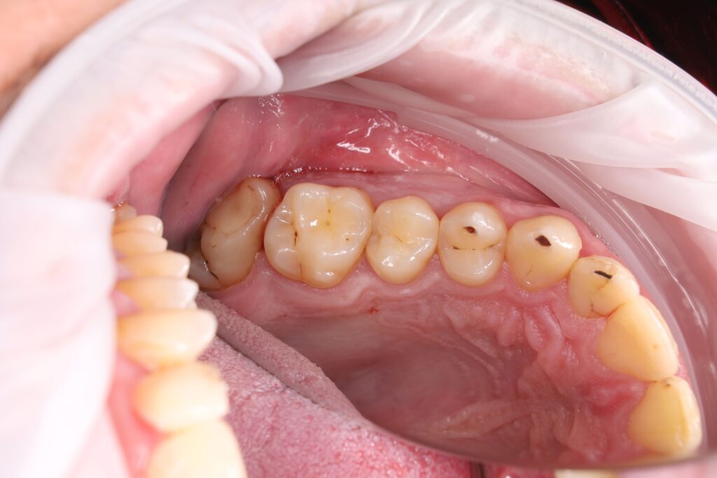 Caries treatment and aesthetic restoration with composite material.