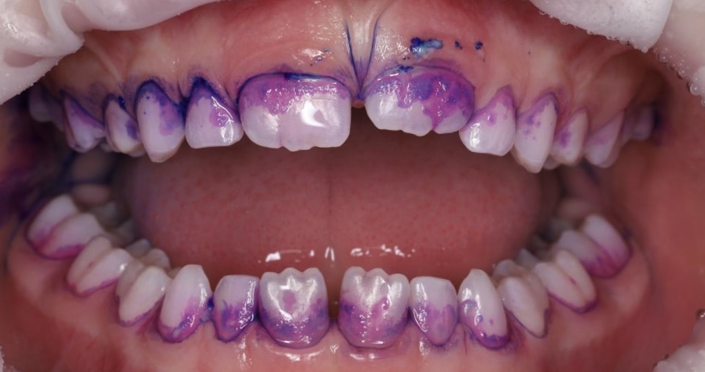 Professional oral hygiene for a child under 8 years of age.
