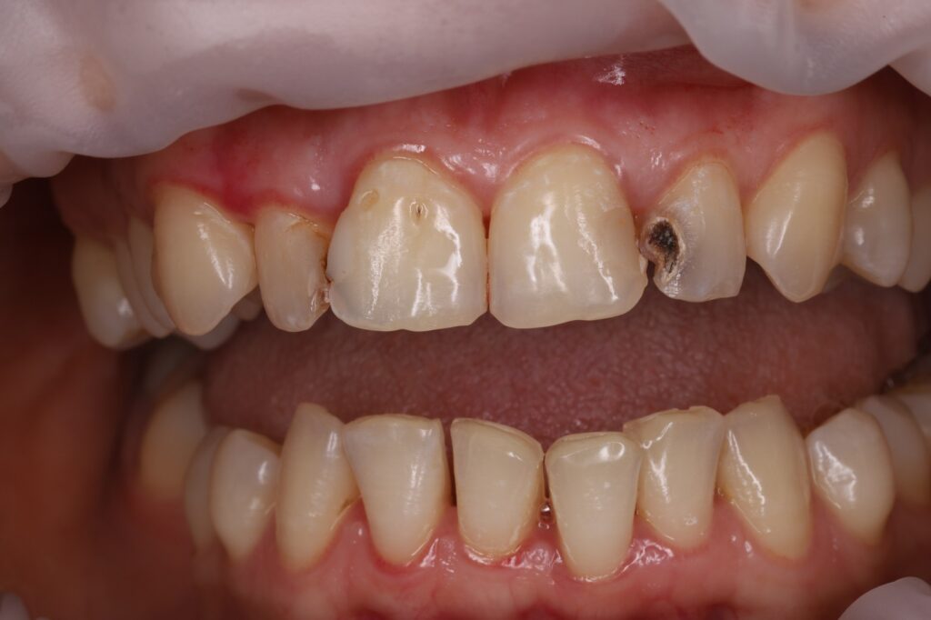 Removal of carious tissues and aesthetic composite restoration of the teeth with anatomical reconstruction.