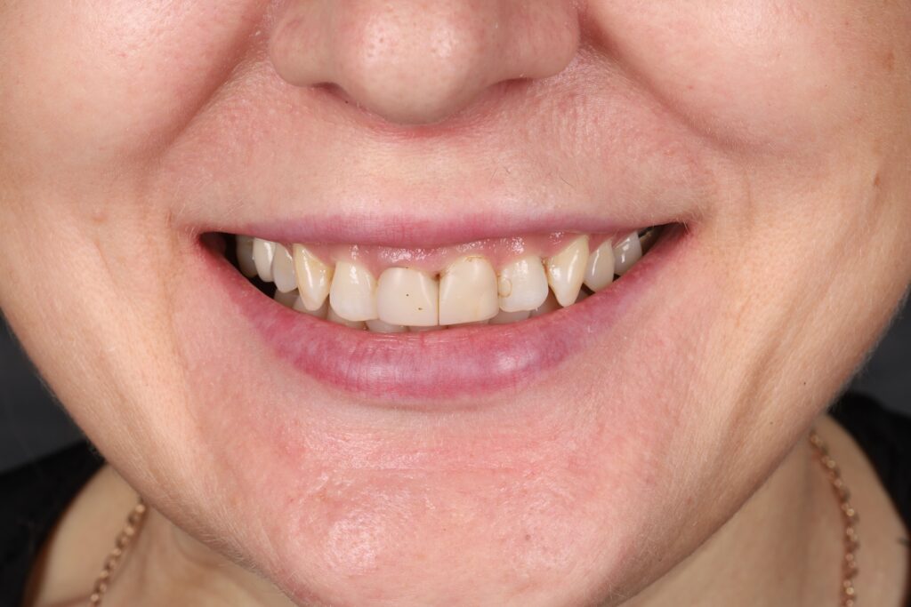 Aesthetic Rehabilitation of the Anterior Region with Ceramic Crowns and Gingival Contour Correction