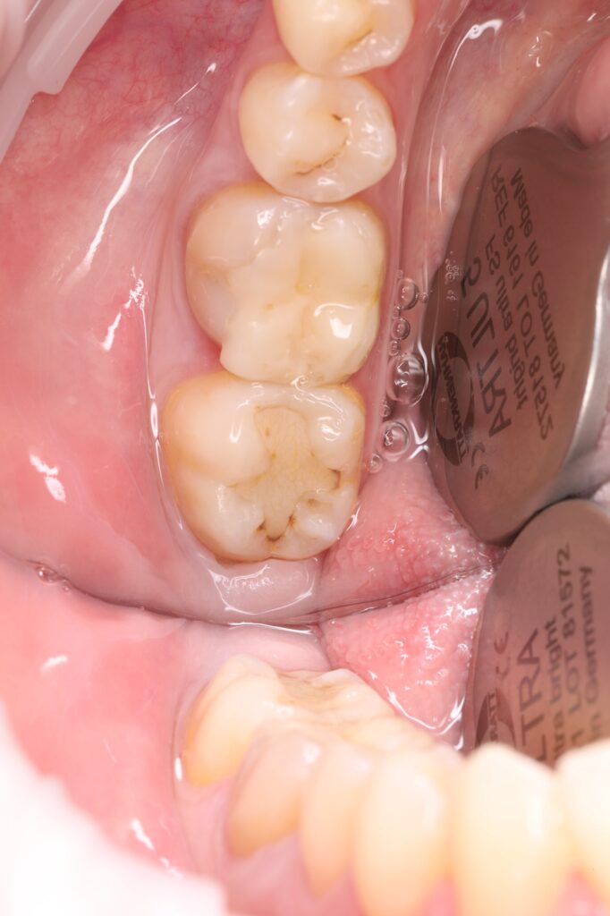 Treatment of a secondary carious lesion