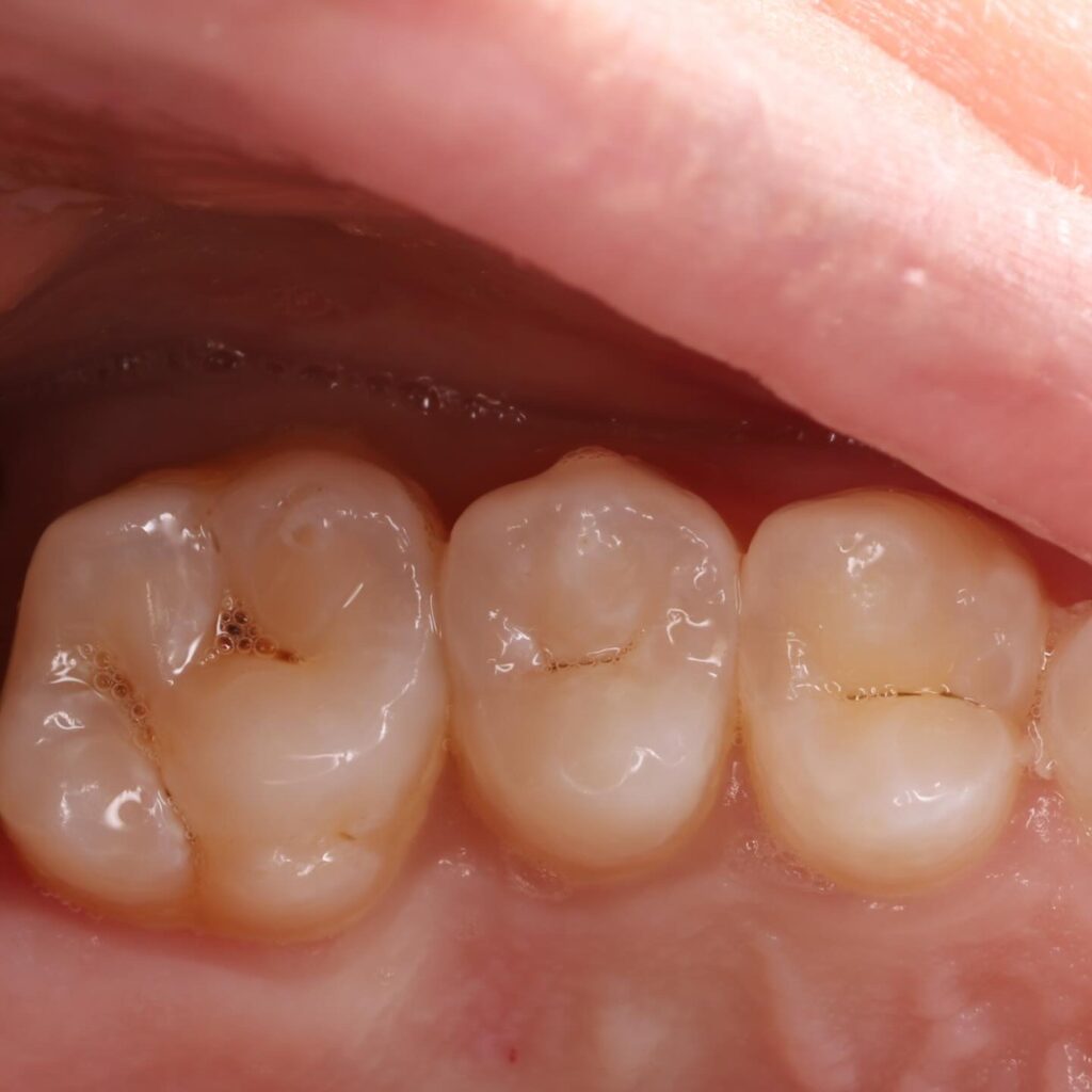 Aesthetic and functional restoration of posterior teeth