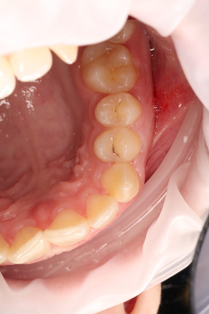 Aesthetic dental restoration with anatomical reconstruction.