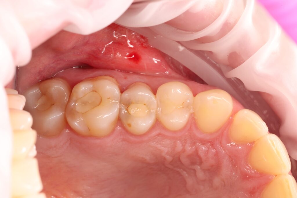 Aesthetic and functional composite restoration of tooth 25.