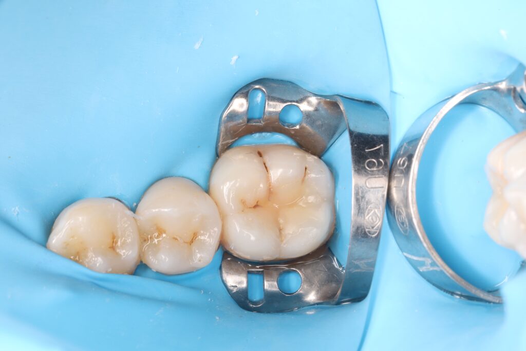 Treatment of a secondary carious lesion.