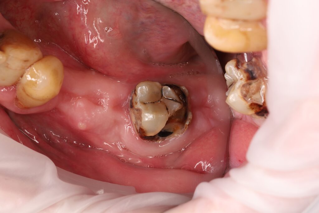 Caries treatment and composite core restoration of the tooth for subsequent prosthetic rehabilitation.