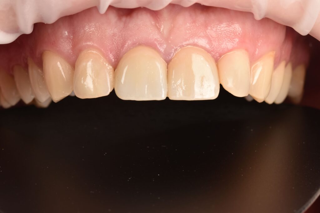 Restoration of Esthetics and Function of the Anterior Teeth Using Crowns