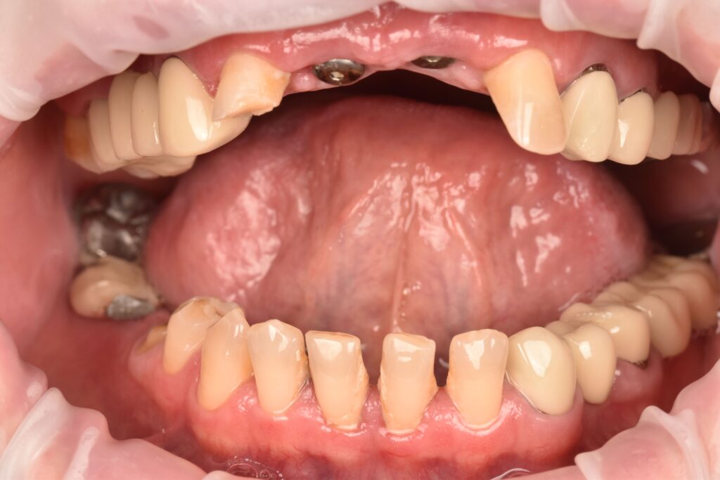 Prosthetic Rehabilitation of the Anterior Teeth Using Dental Implants and Zirconia Crowns