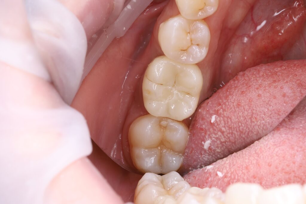 Restoration of a Posterior Tooth Using a Dental Implant and Crown