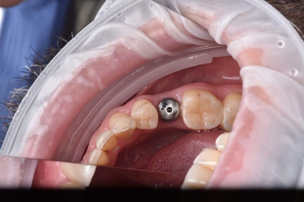 Placement of a Zirconia Crown on an Implant with Digital Planning
