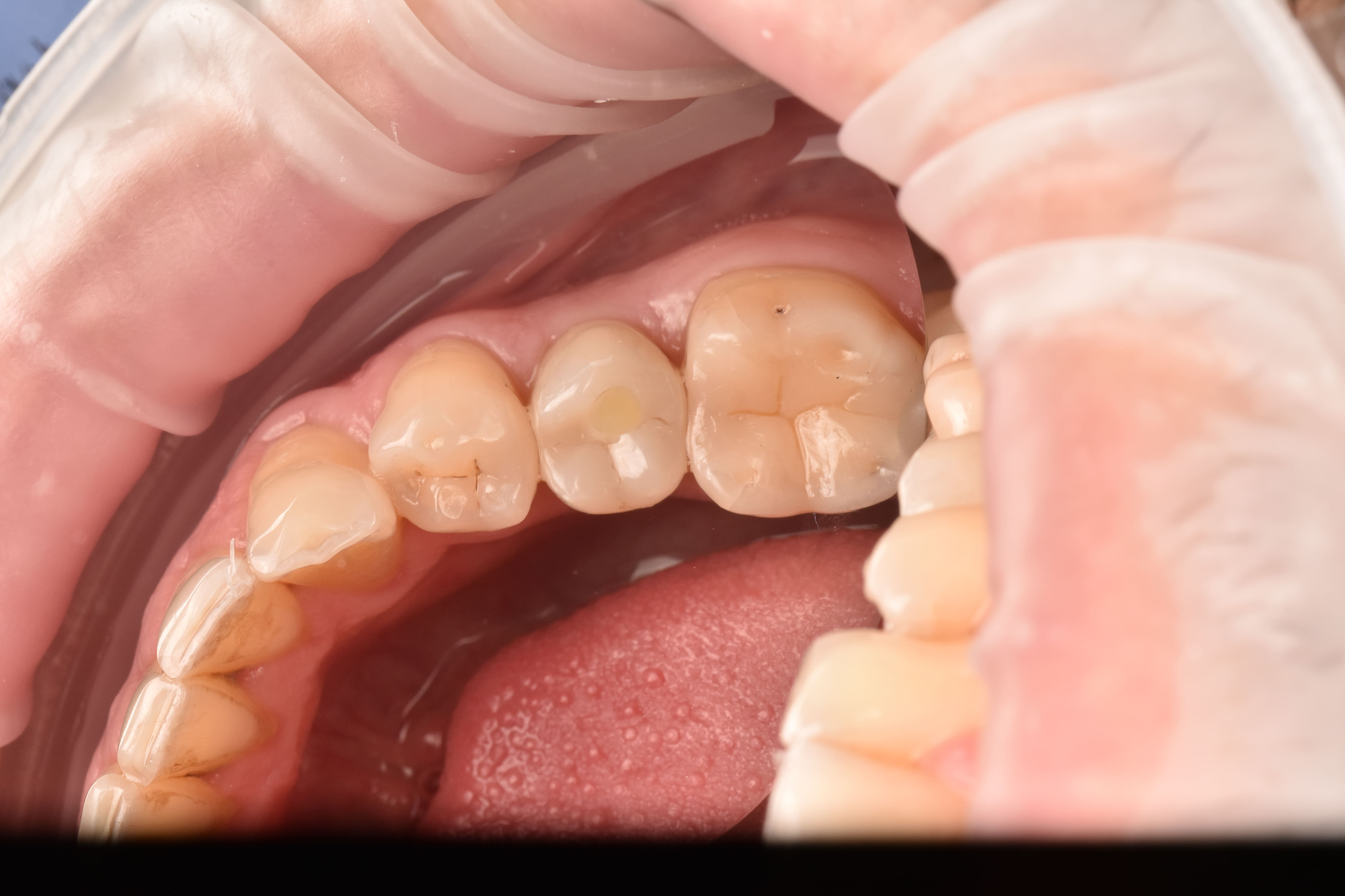 Placement of a Zirconia Crown on an Implant with Digital Planning