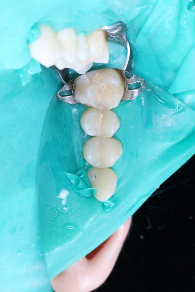 Caries Treatment and Aesthetic Restoration of Teeth