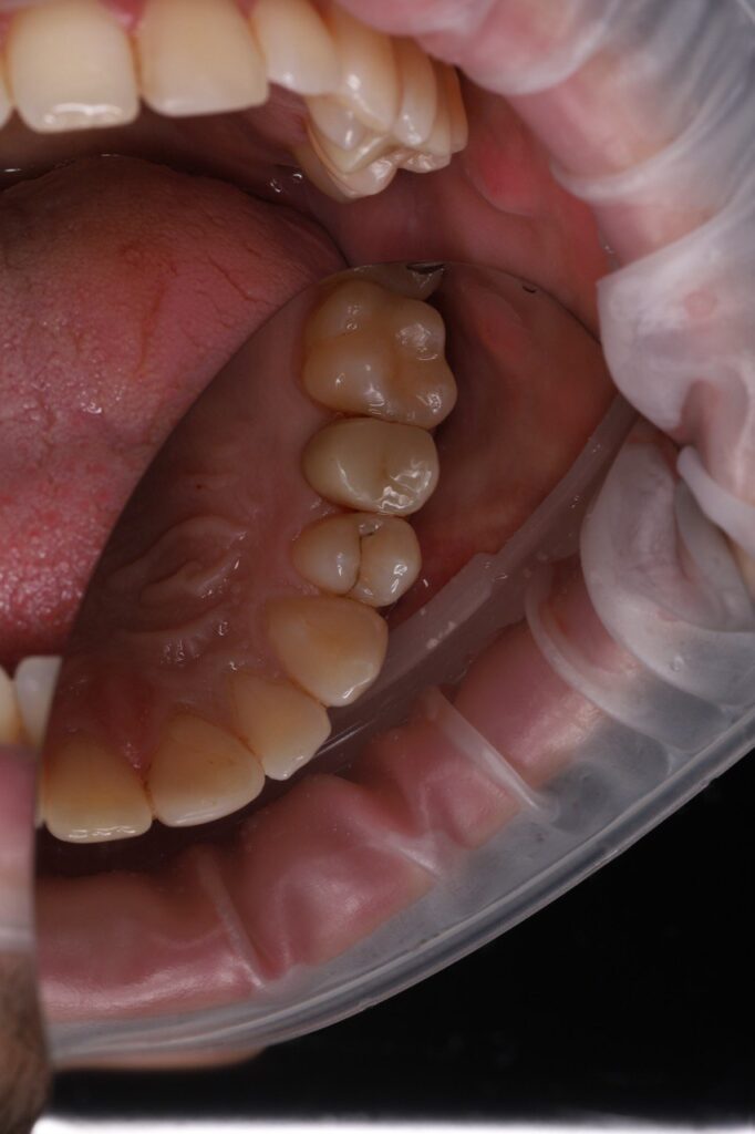 Aesthetic Restoration of Tooth 24 Using a Light-Cured Composite Restoration