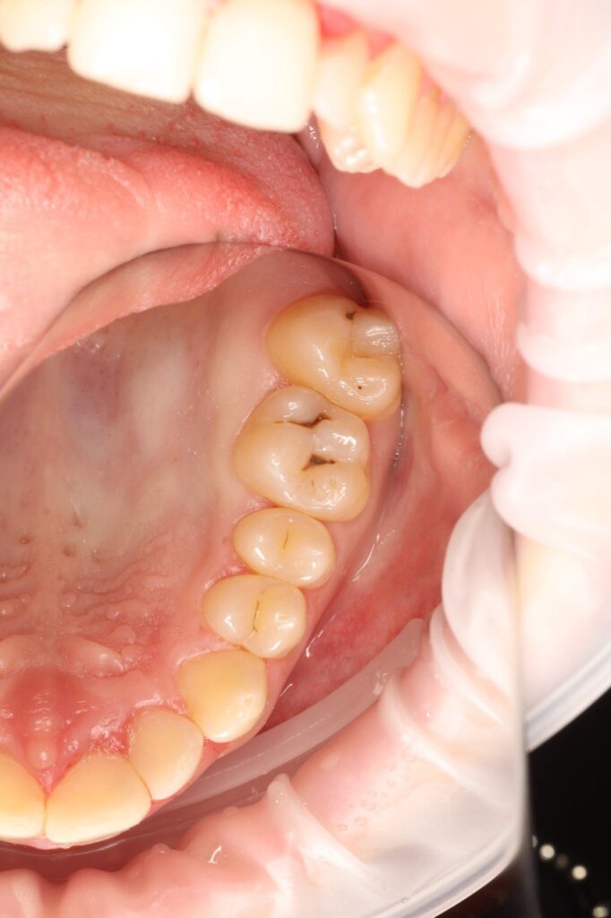 Restoration of the Anatomical Form of Mandibular Teeth Using Composite Restorations
