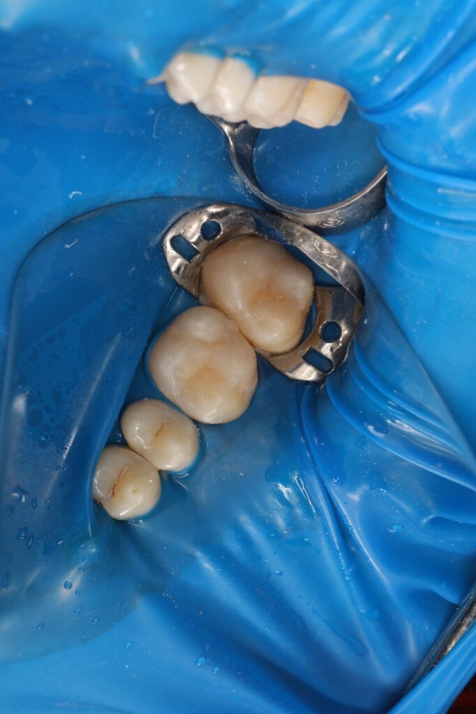 Restoration of the Anatomical Form of Mandibular Teeth Using Composite Restorations