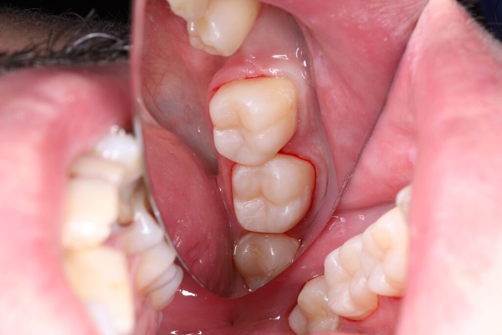 Aesthetic and Functional Restoration of Tooth 24 Using Light-Cured Composite Materials