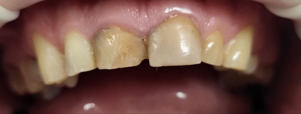Aesthetic Rehabilitation of the Anterior Dentition with E.max Crowns