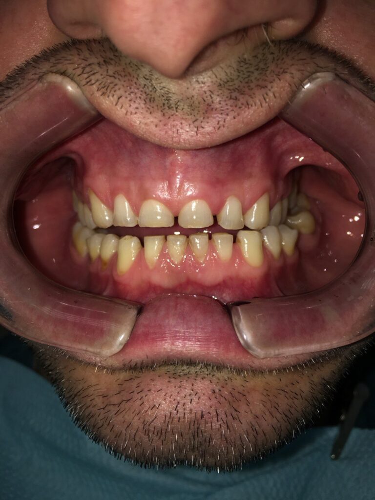 Comprehensive Esthetic and Functional Rehabilitation in Severe Tooth Wear