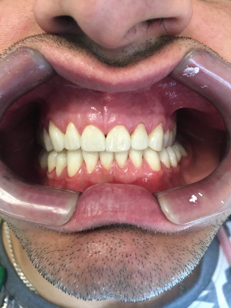 Comprehensive Esthetic and Functional Rehabilitation in Severe Tooth Wear