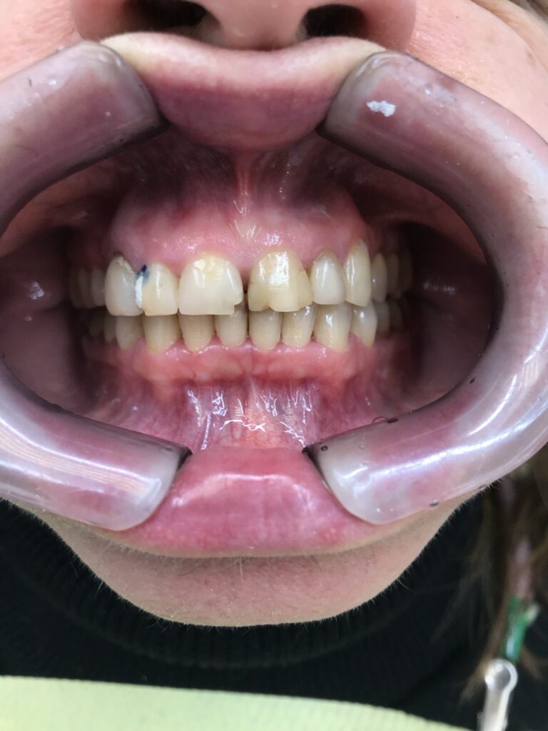 Esthetic and Functional Smile Rehabilitation Using Ceramic Restorations
