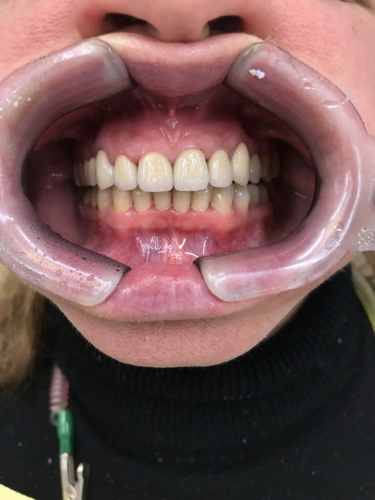 Esthetic and Functional Smile Rehabilitation Using Ceramic Restorations