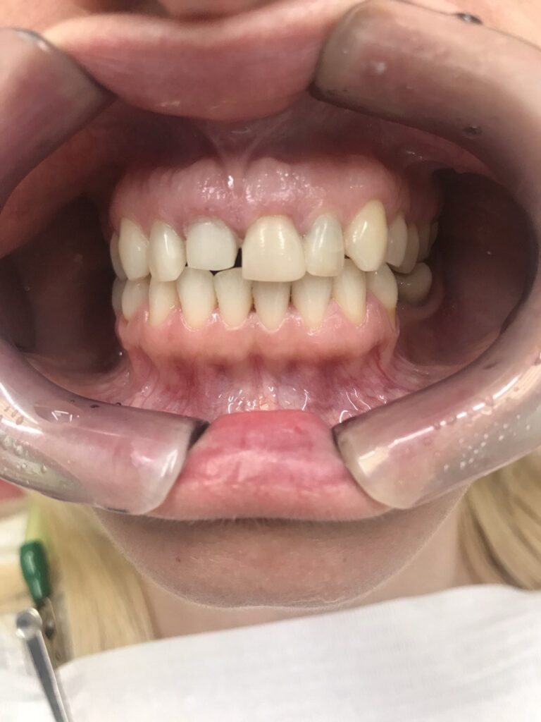 Comprehensive Esthetic Rehabilitation of Teeth Using Ceramic Restorations