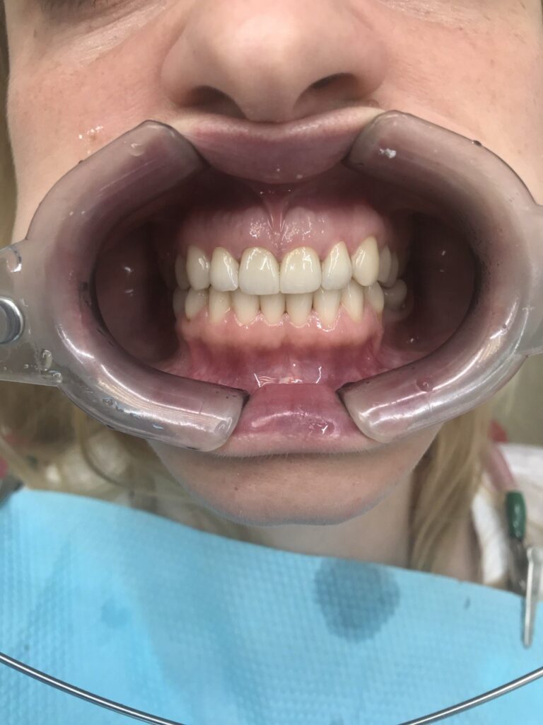 Comprehensive Esthetic Rehabilitation of Teeth Using Ceramic Restorations