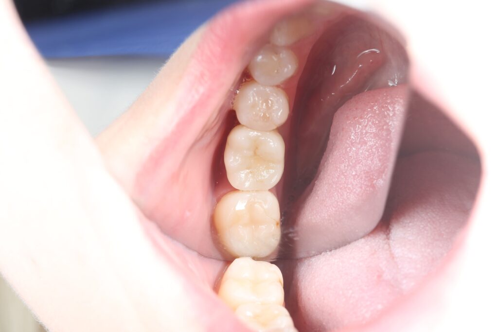 Immediate Implant Placement Followed by Prosthetic Restoration with a Zirconia Crown