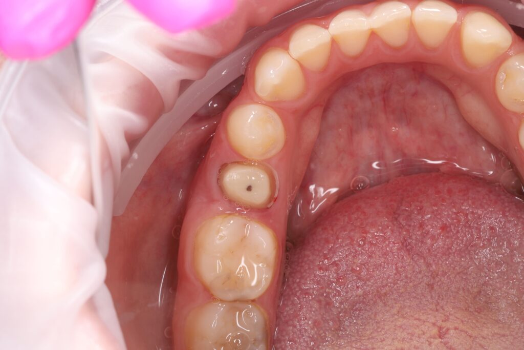 Endodontic Retreatment and Restoration of a Severely Damaged Tooth with a Zirconia Crown