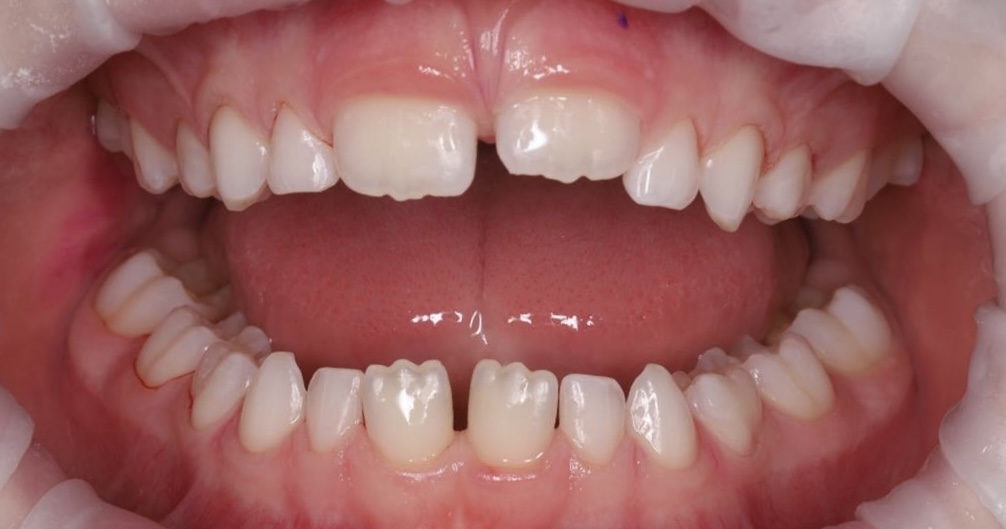 Professional oral hygiene for a child under 8 years of age.