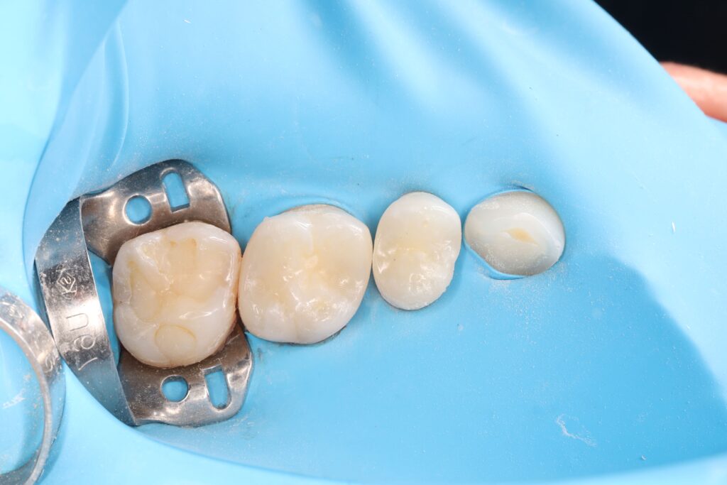 Aesthetic and functional restoration of teeth 26 and 25 with composite material.