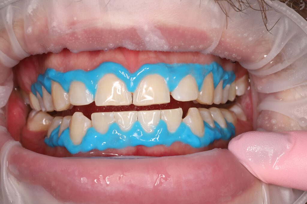 Professional tooth whitening using the Beyond system.