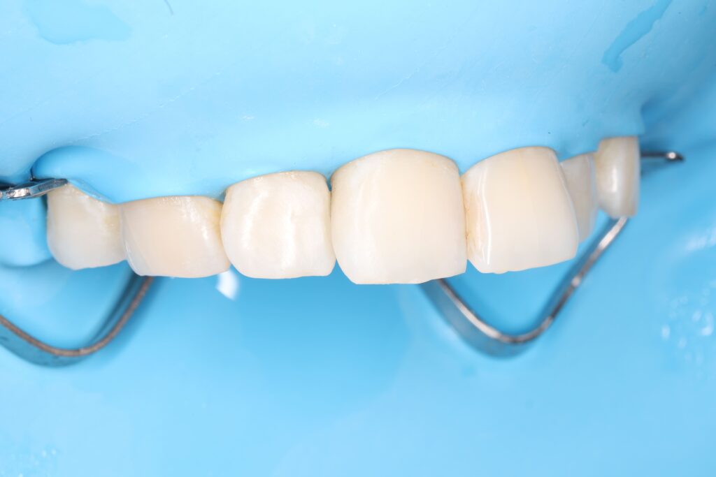 Treatment of secondary caries prior to orthodontic treatment.