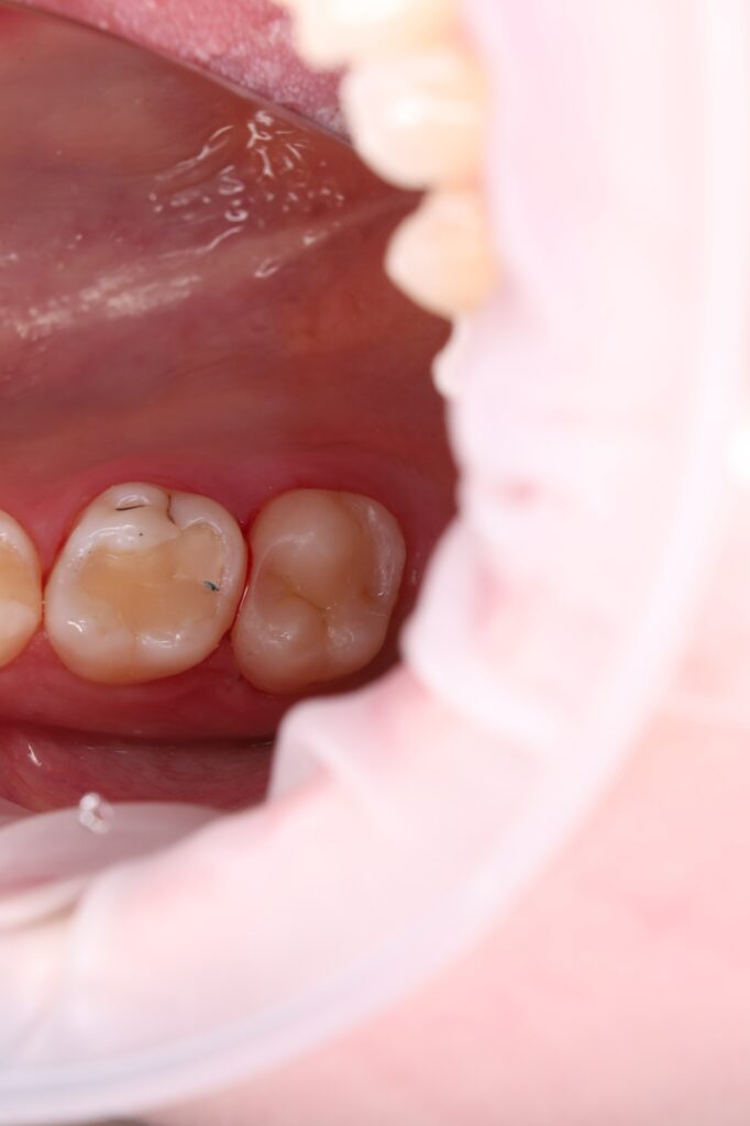 Treatment of interproximal caries and aesthetic restoration with composite material.