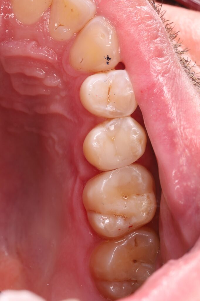 Microscope-assisted endodontic treatment and tooth restoration for subsequent prosthetic rehabilitation.