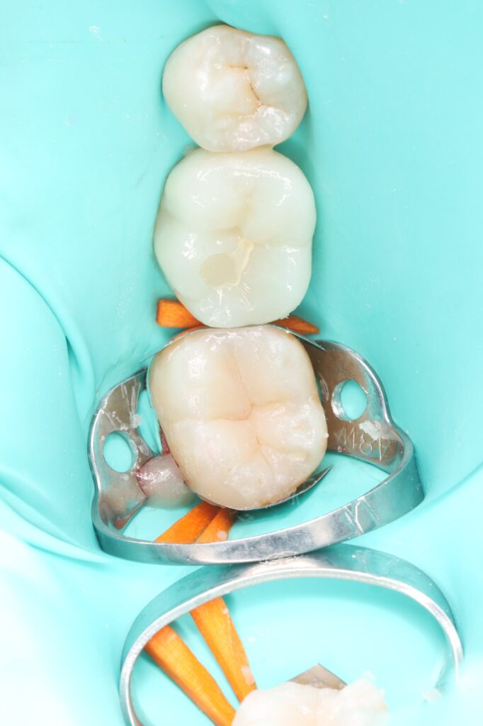 Removal of carious lesions and anatomical composite restoration of the tooth.