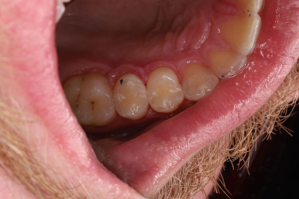 Removal of carious lesions and anatomical composite restoration of the tooth.