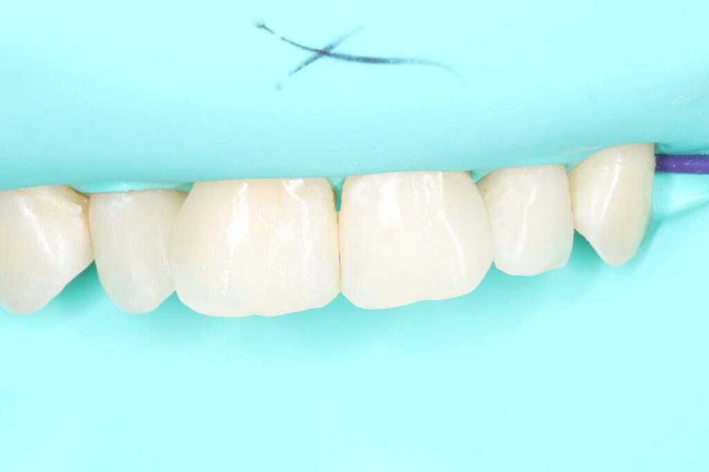 Removal of carious tissues and aesthetic composite restoration of the teeth with anatomical reconstruction.