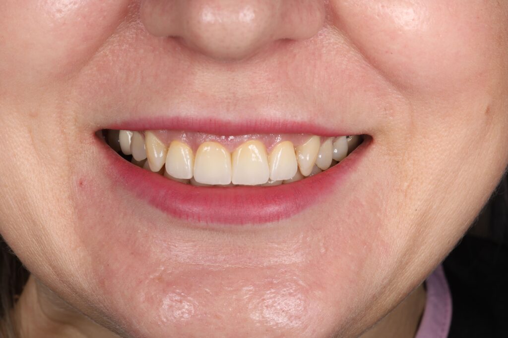 Aesthetic Rehabilitation of the Anterior Region with Ceramic Crowns and Gingival Contour Correction