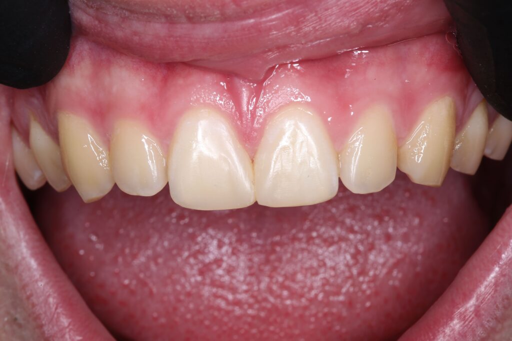 Aesthetic Closure of Diastema Using Composite Restoration