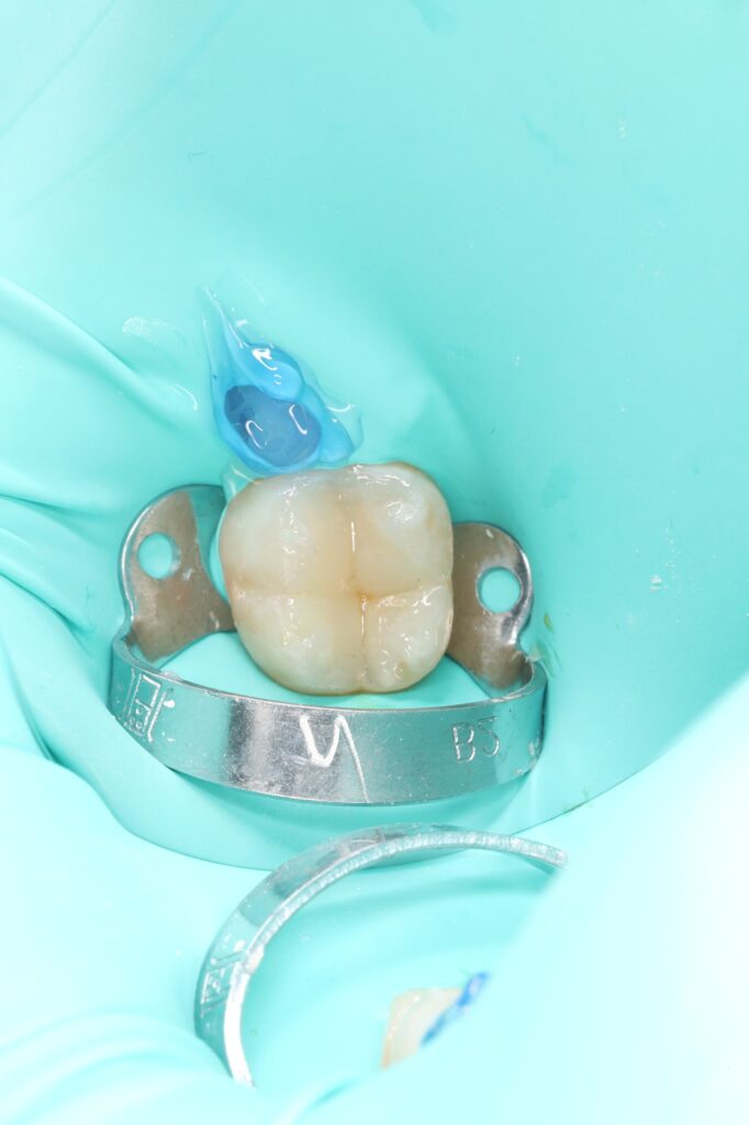 Treatment of a secondary carious lesion