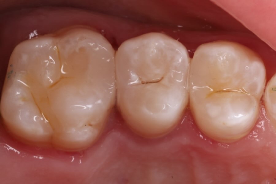Aesthetic and functional restoration of posterior teeth